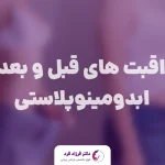 مراقبت های قبل و بعد از ابدومینوپلاستی