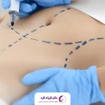 جراحی زیبایی شکم