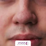 جراحی بینی گوشتی و نتیجه عمل