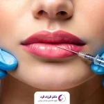 نکات مهم تزریق ژل لب همراه با نمونه کار و ویدئوهای جذاب