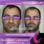 نمونه‌کار جراحی بینی دکتر فرزادفرد