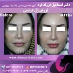 نمونه‌کار جراحی بینی