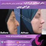 نمونه‌کار جراحی بینی