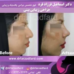 نمونه‌کار جراحی بینی