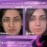 نمونه‌کار جراحی بینی