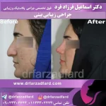 نمونه‌کار جراحی بینی