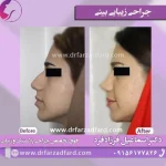 نمونه‌کار جراحی بینی