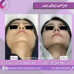 نمونه‌کار جراحی بینی