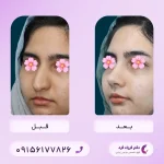 نمونه‌کار جراحی بینی