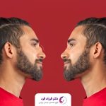 مهم‌ترین تفاوت بینی گوشتی با استخوانی