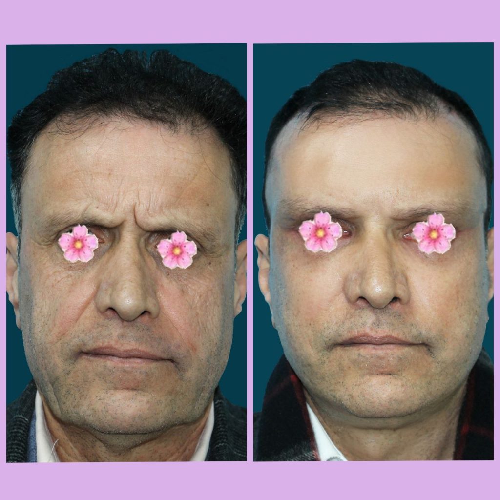 نمونه کار عمل لیفت صورت در مشهد