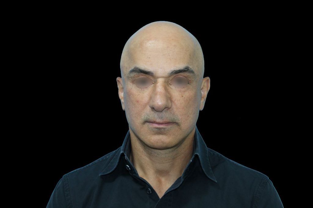 نمونه کار عمل لیفت صورت در مشهد