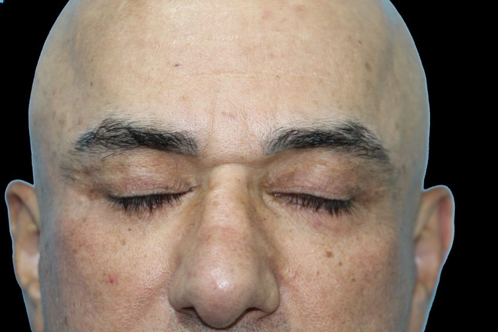 نمونه کار عمل لیفت صورت در مشهد
