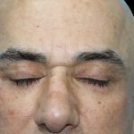 نمونه کار عمل بلفاروپلاستی در مشهد