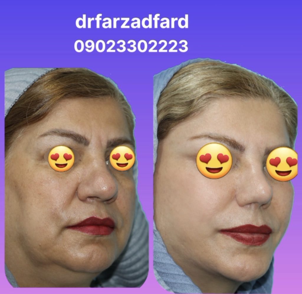 نمونه کار عمل لیفت صورت در مشهد