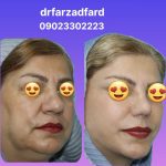 نمونه کار عمل لیفت صورت در مشهد