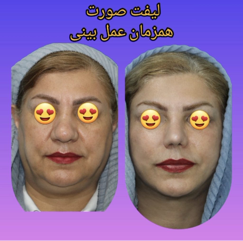 نمونه کار عمل لیفت صورت در مشهد