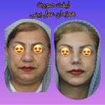نمونه کار عمل لیفت صورت در مشهد