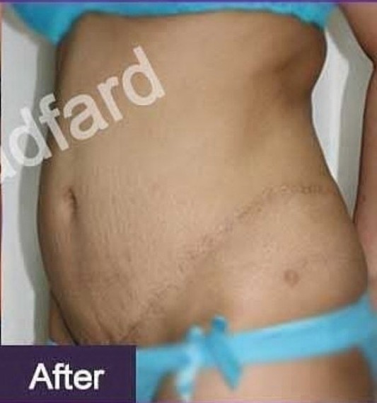 Drfarzadfard-Abdominplasty-after-E