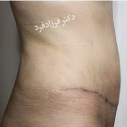 تصویر بعد جراحی زیبایی شکم - دکتر اسماعیل فرزادفرد