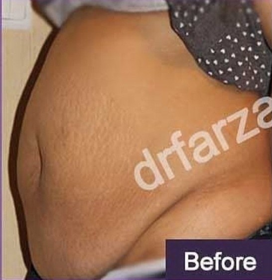 تصویر بعد جراحی زیبایی شکم - دکتر اسماعیل فرزادفرد