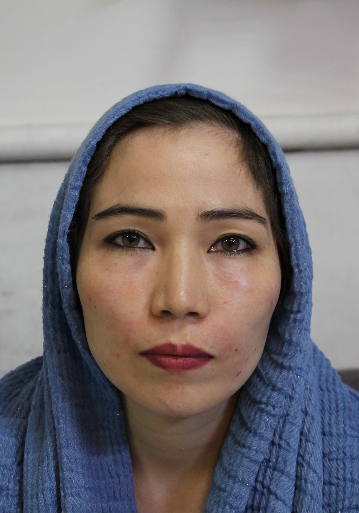 نمونه بعد جراحی لیفت صورت-دکتر اسماعیل فرزادفرد
