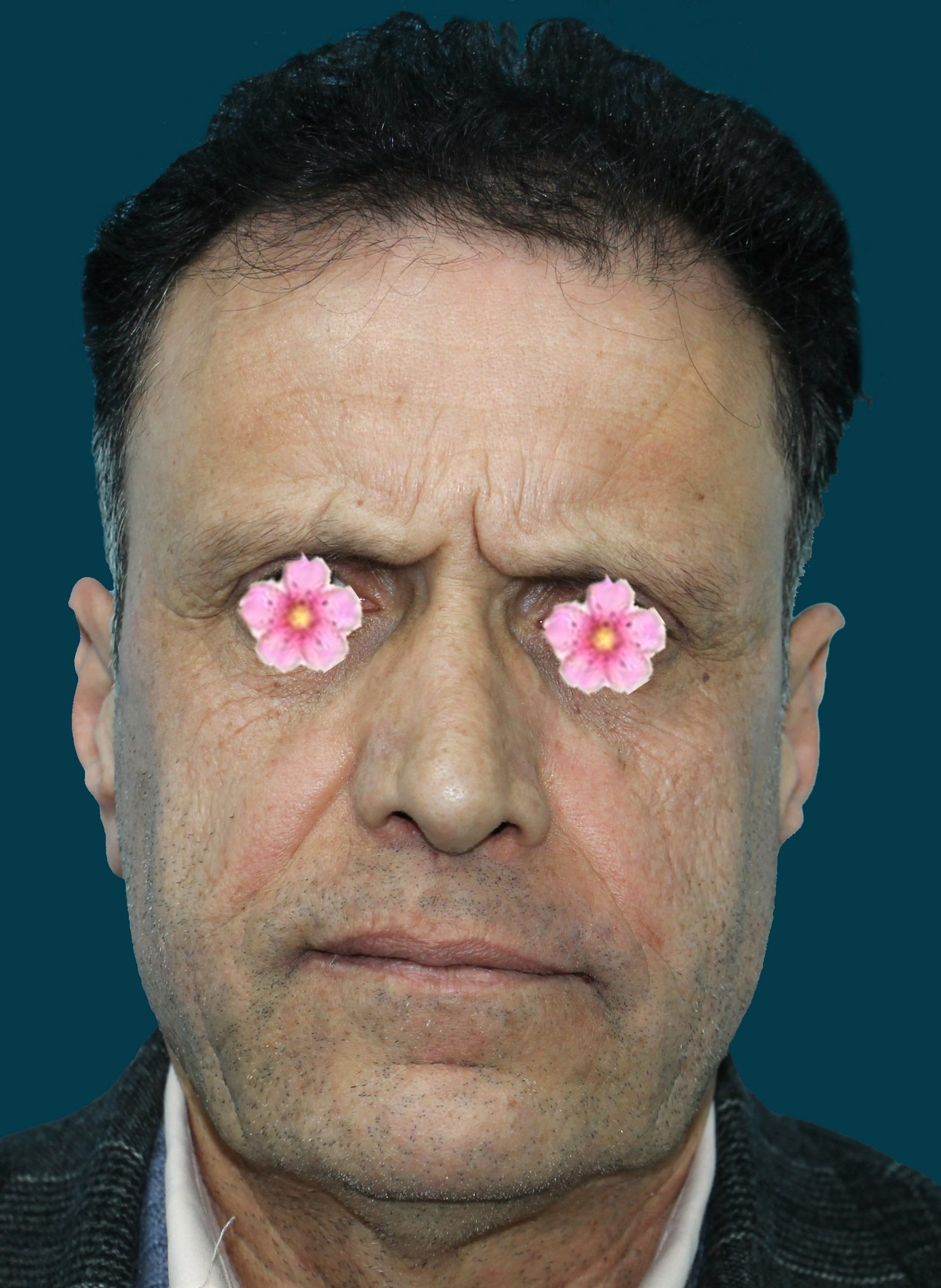 نمونه قبل جراحی لیفت صورت-دکتر اسماعیل فرزادفرد