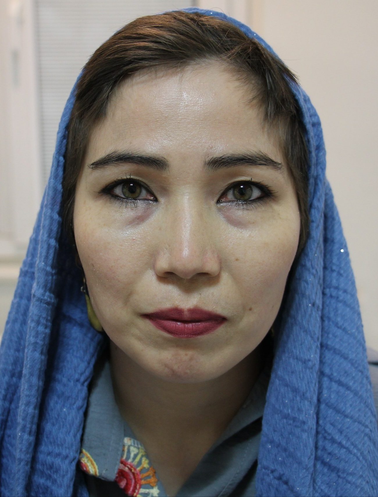 Facelift-Drfarzadfard-befor-C