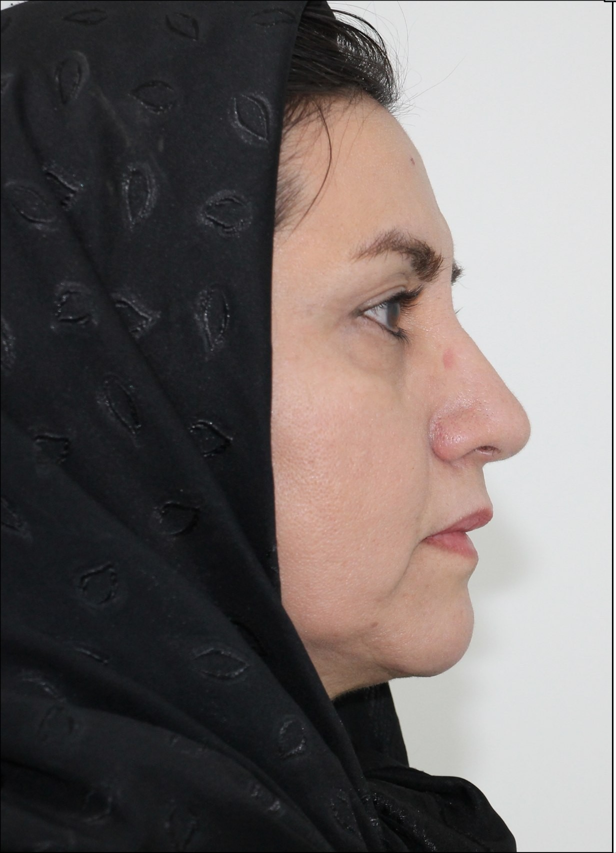 نمونه قبل جراحی لیفت صورت-دکتر اسماعیل فرزادفرد